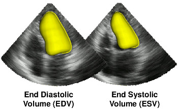 illustration of the segmentation task in 3D echo