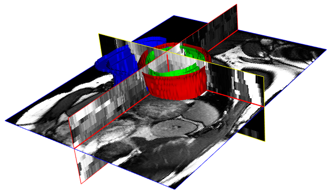 illustration of the segmentation task in 3D MRI