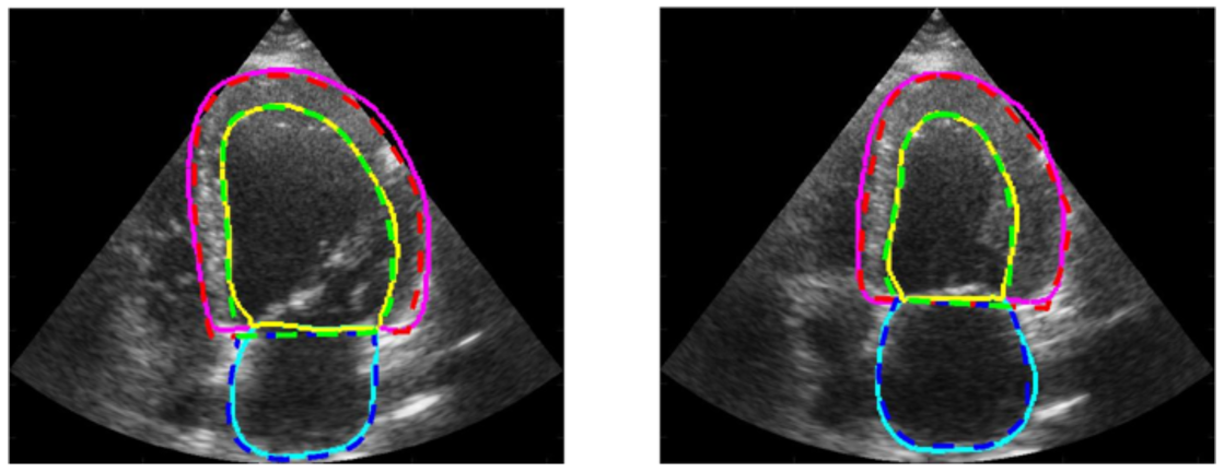 illustration of the segmentation task in 2D echocardiography