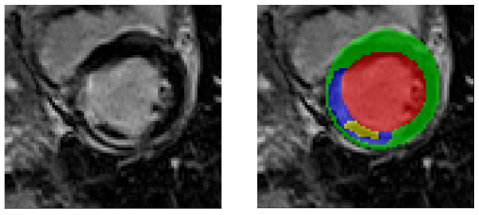 illustration of the segmentation task in 3D MRI