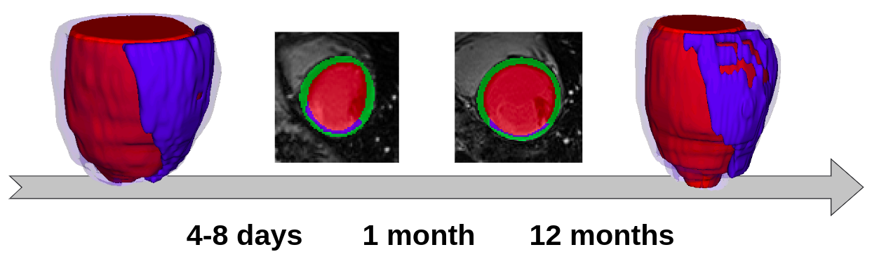 illustration of the segmentation task in 3D MRI