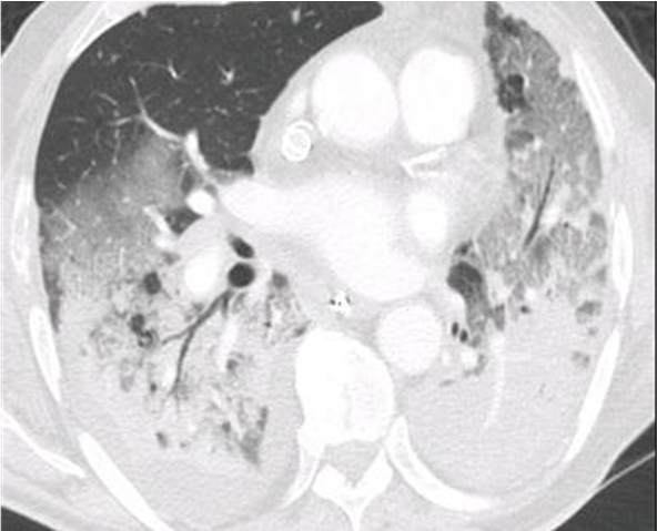 Scanner thoracique d'un patient avec SDRA