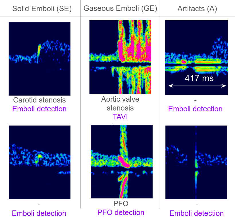 Some examples of solid emboli, gaseous emboli and artefacts spectrograms
