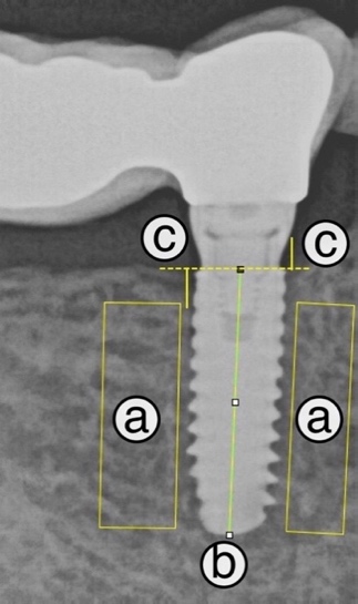 Méthodologie de mesure du MBL implantaire
