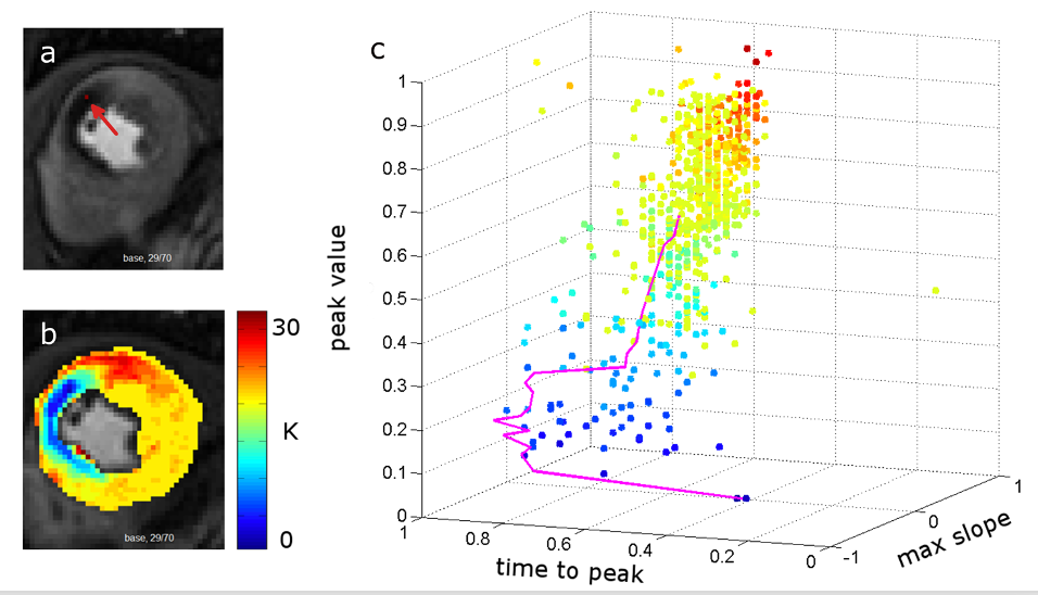 Perfusion myocardite: Automatic detection of lesion localisation and characterization