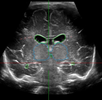 Coronal_view_GT