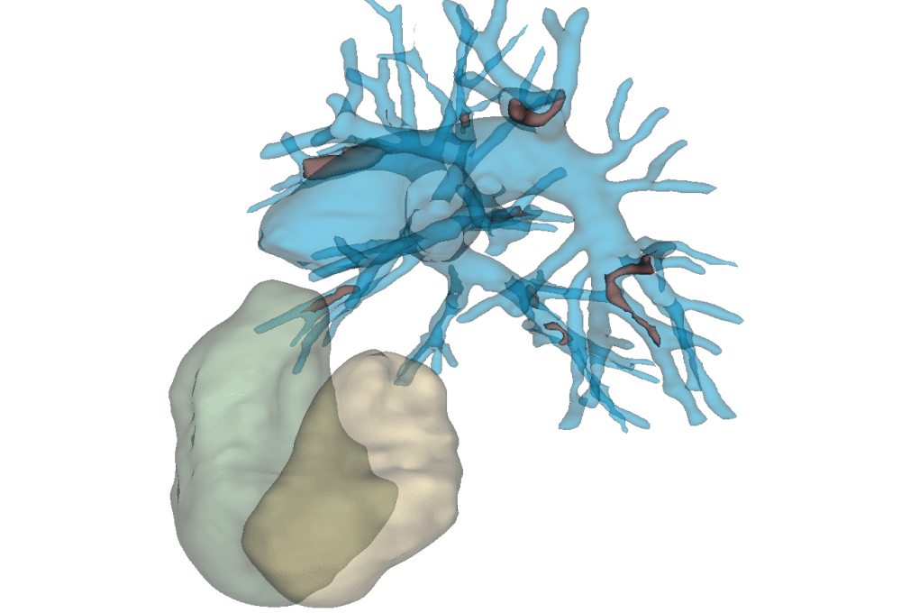 Heart ventricles, pulmonary arterial tree and emboli segmented out from a thoracic CT scan