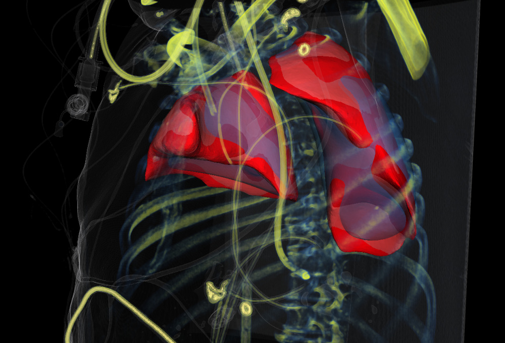 Automatic segmentation of lungs in a severe case of ARDS