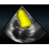 Challenge on left ventricle segmentation