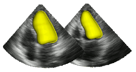 Left Ventricle Segmentation in 3D Echocardiography