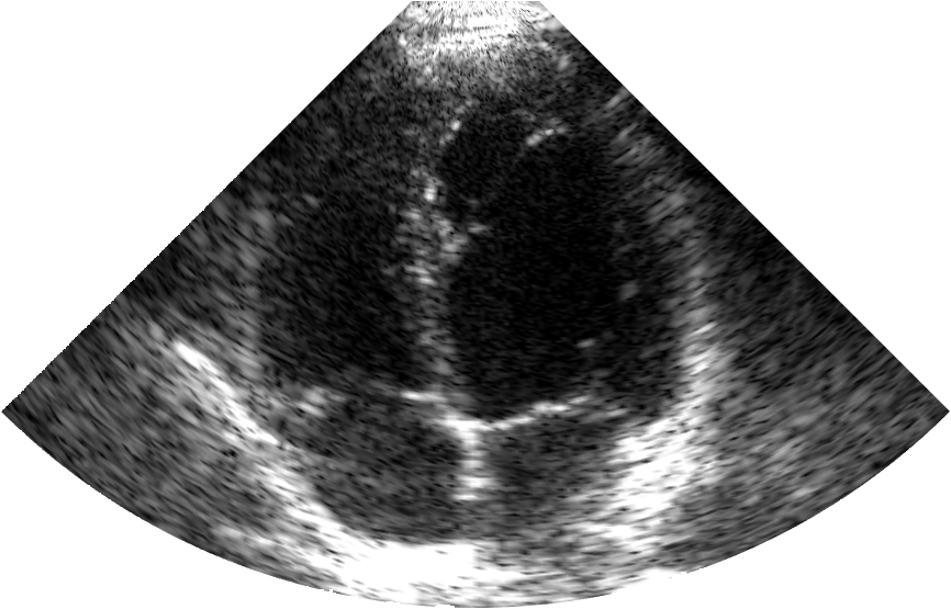 Ultrafast Echocardiography