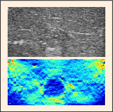 elastography example