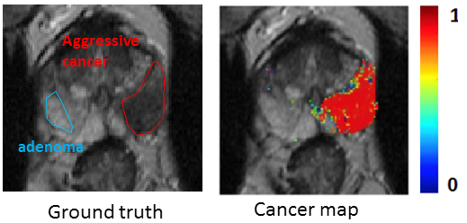 CAD_prostate