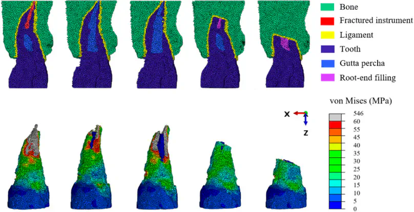 Decision Support for Removing Fractured Endodontic Instruments: A Patient-Specific Approach